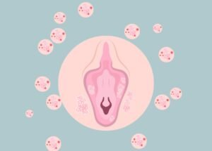 Anatomical illustration of the vulva with white patches, surrounded by pink circles showing virus particles