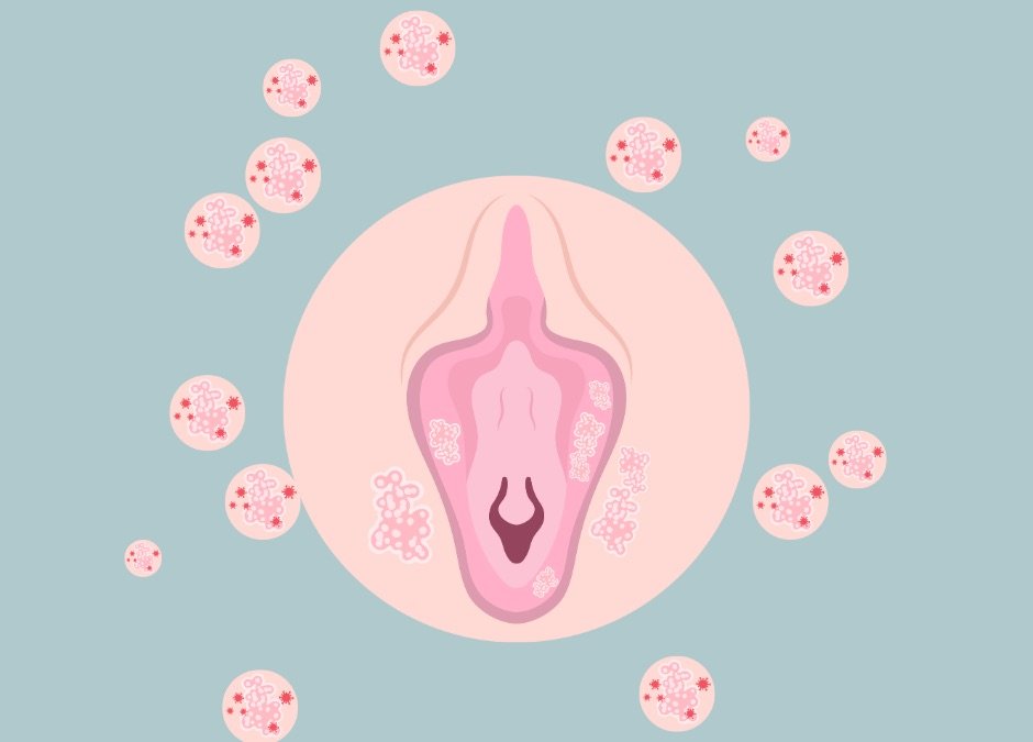Anatomical illustration of the vulva with white patches, surrounded by pink circles showing virus particles